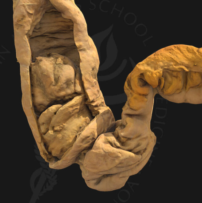 Intussusception (Open Window) Intussusception (Open Window)
